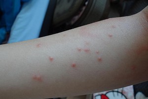 若不慎被昆蟲叮咬後可患上蟲咬性皮炎。（示意圖源：互聯網）