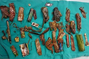 從該病人的胃部和消化管道中取出的大量異物。（圖源：白梅醫院）