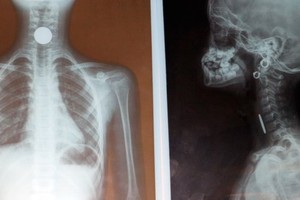 X光片顯示，食道內有一枚類似硬幣的金屬異物卡住。