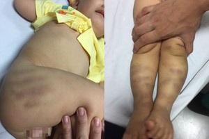 1歲多的男童遭虐待，送至醫院時遍體瘀傷。（圖源：互聯網）