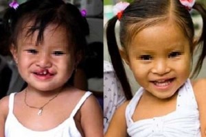 一名唇顎裂女童接受唇顎裂修補手術前後。（示意圖源：市醫藥大學）