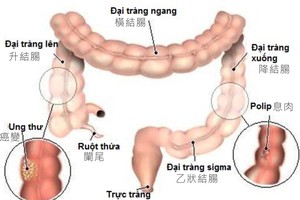 大腸癌發病例日增。（示意圖源：互聯網）