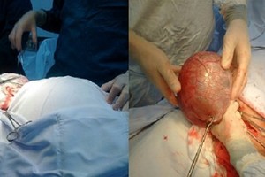 左圖：阮氏Ng.患者接收手術中。右圖：超大卵巢囊腫被成功摘除。（圖源：VTCNEWS）