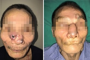 左起：接受整形手術前與後的皮膚癌患者阿Q。