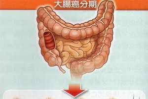 大腸癌病例五至六成發現較晚。（示意圖源：互聯網）