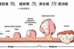 結腸息肉約30年演變為癌前病變，5-10年演變為癌症，後浸潤、轉移