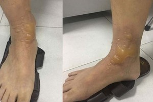 被沸水燙傷出水泡的右腳。（圖源：翠寧）