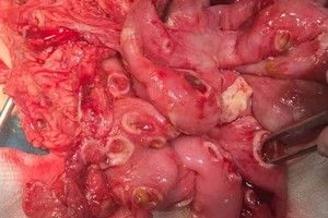 約30釐米長的腸道出現直徑0.5至1釐米的50個破洞。（圖源：秋香）