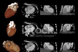 CT 血管造影檢查有助及早發現心臟病。（示意圖源：Getty Images）