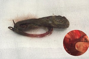 經手術取出的異物。（圖源：雲山）