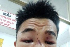 入住大水鑊醫院治療期間的阿盛臉部上的傷勢。（圖源：明山）