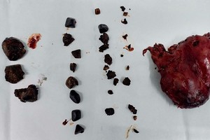 經內窺鏡手術切除的膽囊（右）及取出的膽結石。