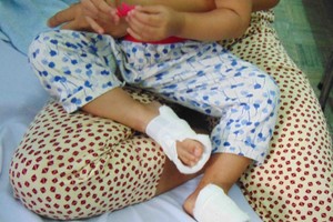 兩腳被燙傷的18月齡兒童還在治療中。（圖源：陳玉）