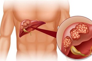 越南肝癌病例排世界前５名。（示意圖源：互聯網）