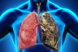 除吸煙外 肺癌還有６大禍首。（示意圖源：互聯網）