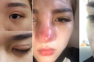 希望擁有更美的外貌，許多整容者遭遇後遺症。