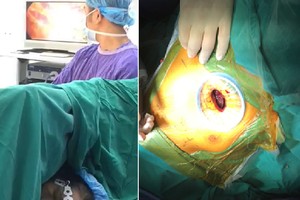 越德醫院成功應用非氣管插管全身麻醉及單孔胸腔內窺手術等新技術為患者割除肺腫瘤。（圖源：黎石）