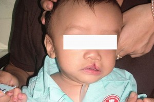 獲免費治療的一名兔唇少兒。（圖源：市口腔頷面醫院）