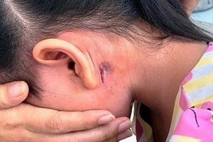 感染Whitmore病毒的 P.B.T.N女病童於本月3日入住醫院接受治療。（圖源：志心）