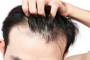 新研究指出，空氣污染可能導致禿頭。（示意圖源：互聯網）