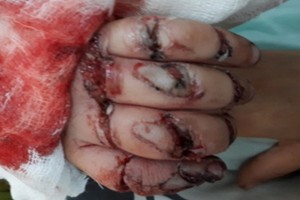 病童的手掌傷勢十分嚴重。（圖源：院方提供）