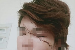 受害者的臉部遭歹徒劃傷，要送醫縫25針。（圖源：受害者提供）