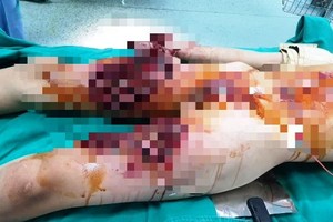 范春 L 的傷勢十分嚴重。（圖源：院方提供）