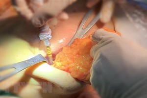 JW美容醫院醫護團隊從患者的右胸中取出矽膠塊。