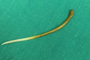 經軟管內窺鏡手術從患者的消化道取出一根長約5釐米的魚刺。（）