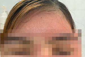 N.T.H 入院求治時的臉部。（圖源：院方提供）