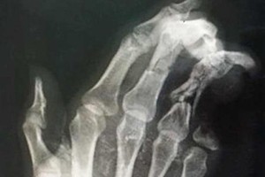 X-射線顯示傷者左手小指斷失了2節。（圖源：院方提供）