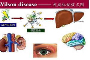 肝豆狀核變性，又稱威爾遜病。（圖源：互聯網）