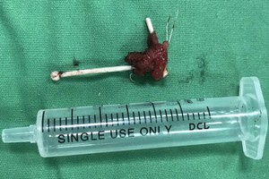 經手術取出體外的T型節育環。（圖源：院方提供）