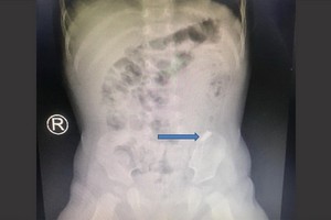 X光照片顯示，病童的大腸處呈現一片碎鏡的異物。（圖源：院方提供）