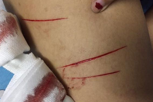 女生腿部被劃傷的傷勢。（圖源：何莊）