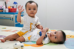 竹兒-妙兒在進行分離手術前。