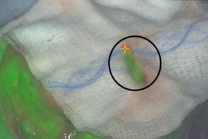 ICG 染劑使狗胸部癌細胞發出綠色螢光，同時也發現癌細胞已擴散到淋巴結（黑色圓圈處）。（圖源：Penn Vet）