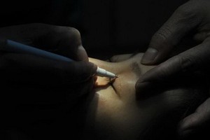 割雙眼皮手術。（示意圖源：互聯網）