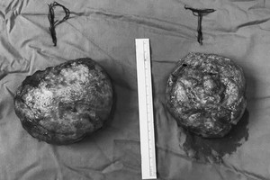 經手術取出的兩塊乳房植入物。（圖源：院方提供）