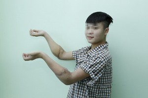 圖為一名接受雙手前臂移植手術後的年輕受贈者。（圖源：院方提供）