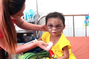 一名 4 歲的女童長期遭親母及繼父虐打，臉部遭重擊腫脹。