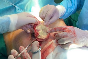 手術隊伍將患者在接受隆胸手術時被遺留的紗布取出體外。（圖源：C.T.V）