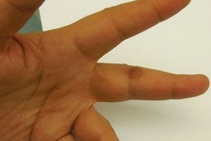 疫情停課在家狂玩3C？小心得皮膚病！