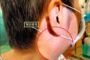 因疫情拖半年才就醫  耳後腫塊竟是這個癌轉移