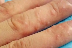 一到夏天就長的“小水泡”