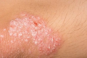 皮炎分為３大類，脂溢性皮炎５大誘因