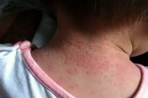 寶寶長痱子，父母要做好這５件事！