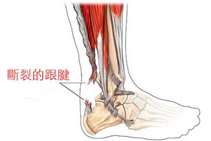 跟腱斷裂到底有多恐怖？