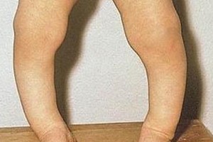 佝僂病４大誘因不可不防！