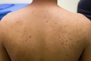 治療肌肉發炎卻引爆毛囊炎 